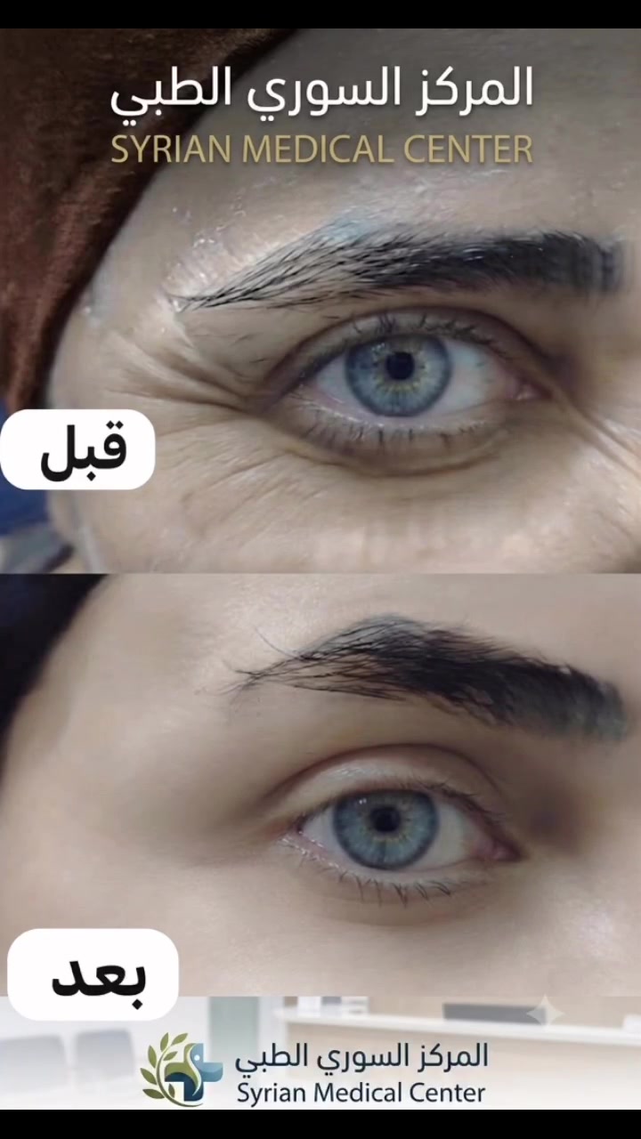 المركز السوري الطبي 
😍😍😍 😍😍😍نتيجه حقن البوتوكس لتجاعيد مابين الحاجب والجبهه وماحول العينين   💉🥼🩵 
كافة خدمات التجميل متوفرة بمركزنا ( للنساء والرجال )
وتحت أيادي أطباء اختصاص
متواجدين كل أيام الأسبوع 
المعاينة مجانا

النتيجه من (4_14 ) يوم  ❤️❤️
#فلر #مدينة_الصدر #المحمودية
#المركز_السوري_الطبي
العنوان المحمودية تقاطع العزاب(المجمع) قرب مقر الفوج الثاني سابقاََ
للحجز والاستفسار مراسلة الصفحة أو الاتصال على الأرقام التالية 📱*********** ***********
