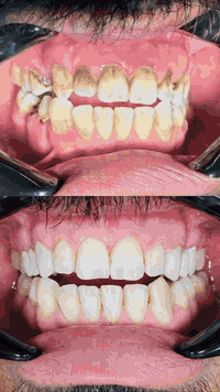 ✨ تحسين الابتسامة خطوة بخطوة ✨

 � النتيجة:
ابتسامة أنظف ✨
لون أفضل 🌿
مظهر صحي وطبيعي �

� العناية بالأسنان ليست رفاهية… بل صحة وجمال
📞 للحجز والاستفسار: (***********)

#Before_After
#DentalCare
#SmileMakeover
#تنظيف_الأسنان
#ابتسامة_صحية
