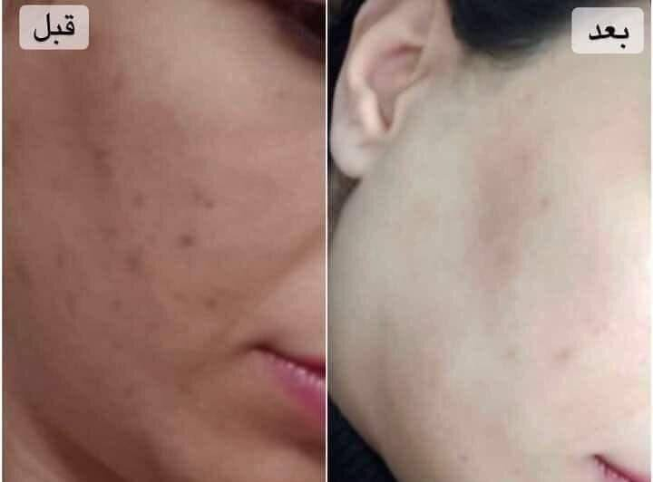 خلطه سن شاين♥♥الاصليه♥♥
معجزة التبيض الضمان حقيقي للمنتج
نتائج واضحة بعد 3 ايام من الاستعمال😲😲😲

 ((مع ابرة النضاره الملكيه)) 

🌹 فوائد الخلطه👇🏻👇🏻👇🏻
1-التبيض 7 درجات. 
2-ازالة التصبغات.
3-ازالة الكلف و النمش.
4-ازالة التجاعيد(ان وجدت).
5-ازالة هالات السوداء تحت العين.
6-تضيق المسامات.
7-ازالة حب الشباب و اثار الحب. 
8-امن للبشرة الحساسة و مناسب لجميع البشرات الدهنية و وجافه
للحجز والاستفسار واتساب رقم تلفون ***********
