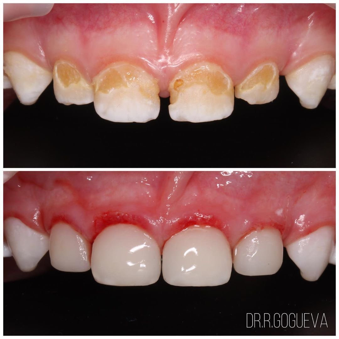 �🦷 أسنان الطفل مو شي ثانوي!
الأسنان اللبنية إذا تضررت → تأثر على الأسنان الدائمية بالمستقبل ❌
والتأجيل يزيد المشكلة أكبر ⏳

لا تستهينون بصحة أسنان أطفالكم 
نقدّم خدمات:
✨ حشوات
✨ قلع
✨ تنظيف
✨ فلورايد وقائي

💙 تعامل لطيف ويا الأطفال
💙 بيئة مريحة
💙 عناية طبية صحيحة
العنوان / شارع المطار /بالقرب من ساحة عباس بن فرناس 
للحجز والاستفسار التواصل عبر واتساب على الرقم 

***********
