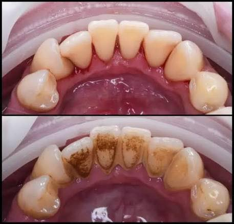 سلام عليكم (((((((العلاج المجاني))))))
اي شخص عنده حالات(تسوس،قلع، تنظيف، طقم اسنان)
يراسلني خاص وعلاج مجاني!!!!!
في عيادات اوروك في منطقة الكراده شارع ٥٢
للتواصل ع ماسنجر او الرقم التالي
 ***********

