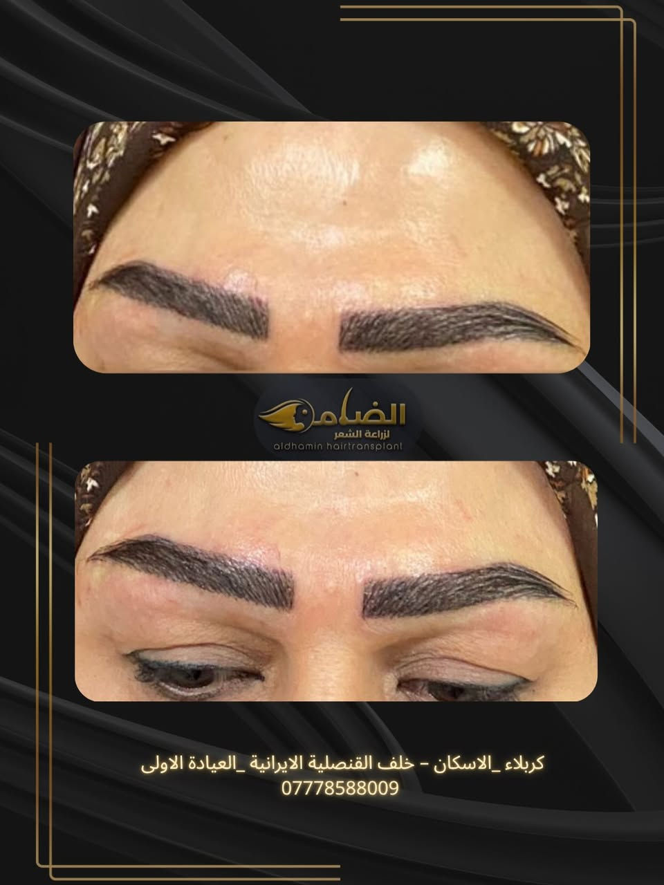 ✨ زراعة الحاجب بتقنية الشريحة ✨

حاجب طبيعي… كثيف… ومرسوم بدقة عالية ✨  
بتقنية الشريحة الحديثة نمنحكِ مظهر حاجب متناسق يناسب تفاصيل الوجه وبنتائج طبيعية جدًا 💎

✔️ كثافة طبيعية  
✔️ رسم دقيق لشكل الحاجب  
✔️ بدون ألم يُذكر  
✔️ نتائج دائمة ومظهر أنيق  

استعيدي جمال حاجبك بثقة ✨  
📍 كربلاء – الاسكان – خلف القنصلية الايرانية – العيادة الاولى  
📞 ***********
