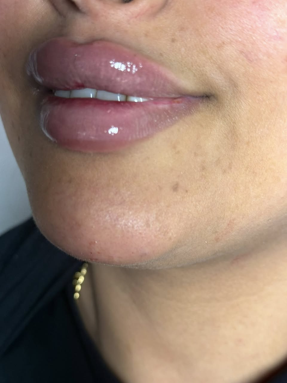 فلر شفة
بدأ تغيييرات العيد حبايب 

احسن شي ممكن تسوونه هسة طبعا الطراوة. تموت لان فلر براند 

العنوان العبيدي مقابل مطعم ليالينا سوق العبيدي مجمع الأمير الطبي الطابق الأول عيادة الدكتورة حوراء الدراجي *********** للحجز
