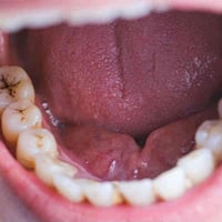 دكتورة اسنان • علاج مجاني • تسوس اطفال