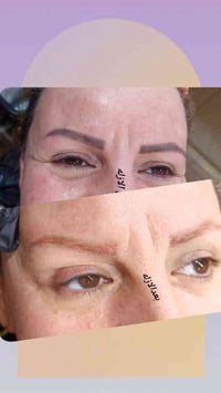 ازالة تاتو • ام محمد • السماوه حي الحسين