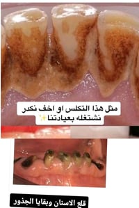 محتاج تنظيف اسنان و ازاله تكلسات  او قلع اسنان متحركه أو جذور تالفه يت...
