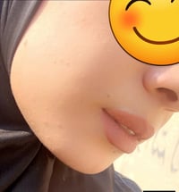 خلطة وجه إيرانية • تزيل الكلف • ضمان ١٠ أيام