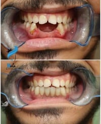 وبركاته يتوفر حالياً إعداد وصناعة طقم أسنان لتعويض الأسنان المفقودة كم...