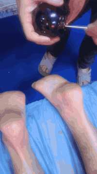 الحجامة الناريةلتحسين تدفق الدم  وتخفيف  تشنجات الساق الليلية وتيبس ال...