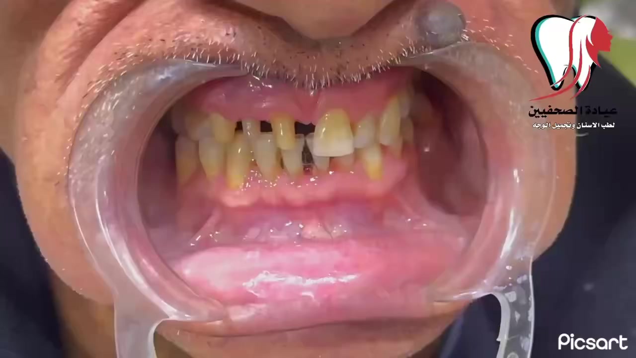 ١: معالجة الاسنان المتضررة 
٢: معالجة اللثة 
٣: ازالة بقاية الاسنان التالفة 
٤: تعويض الاسنان المفقودة 
٥: استخدام تقنية الطباعة الاليكترونية 
٦: تغليف الاسنان بالزاركون الاماني 
النتيجة 🔥🔥✔️

📍العنوان البلديات / الصحفيين على يمين افران ومعجنات عسل ( مقابل الساحات الترابية )

للاستفسار والحجز واتساب-فايبر-تيليجرام:📞 
دكتور الاسنان ازهر الكناني 👨🏻‍⚕️🦷  ***********
دكتورة التجميل 👩🏻‍⚕️🎀 ***********
او مراسلتنا على الخاص
‏INSTAGRAM➡️ @dr_za91
‏Facebook ➡️عيادة الصحفيين لتجميل وتقويم وزراعة الاسنان
