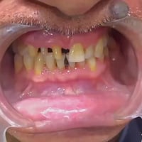 ١: معالجة الاسنان المتضررة  ٢: معالجة اللثة  ٣: ازالة بقاية الاسنان ال...