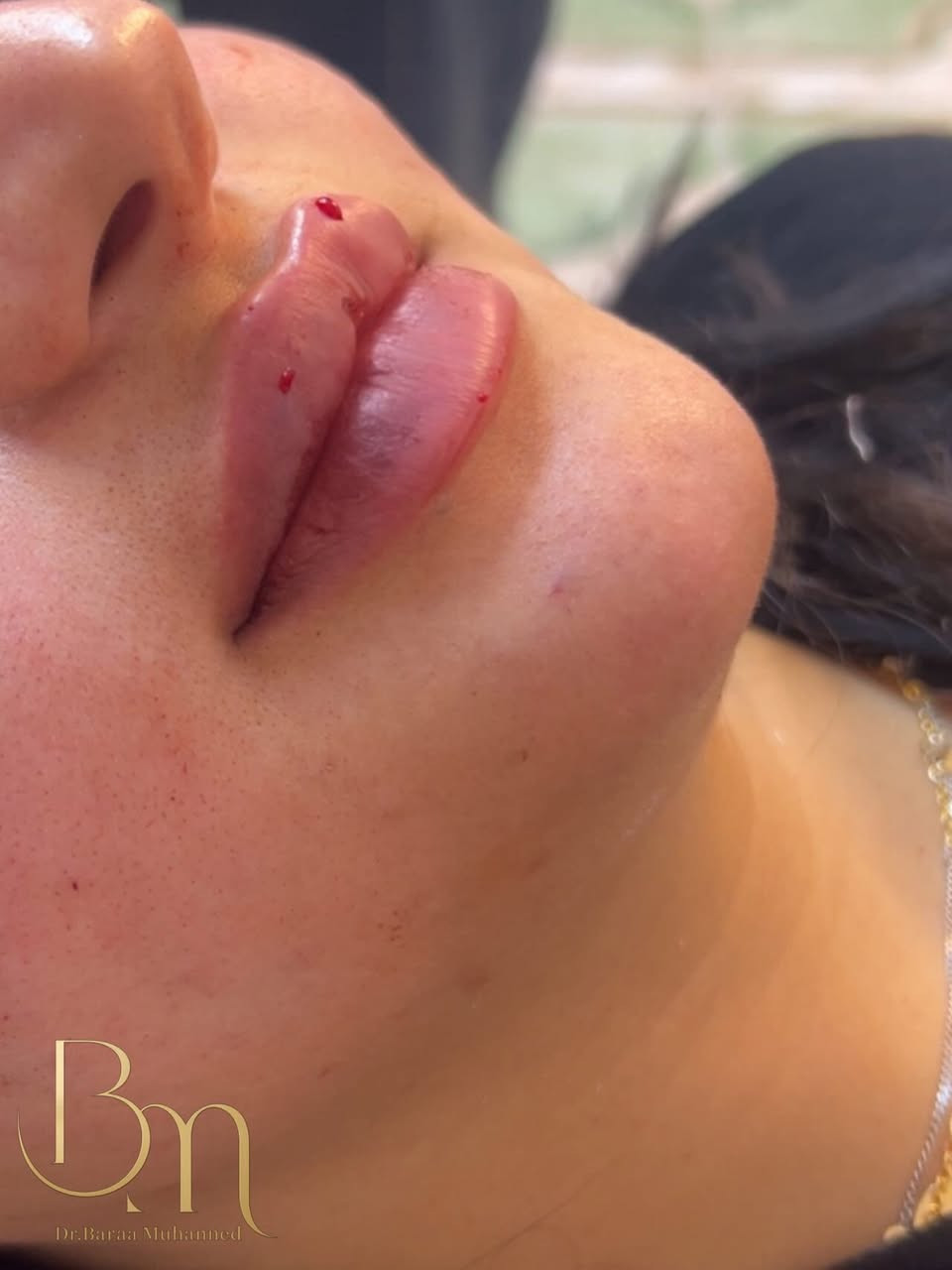 عيادة التجميل الاولى في الحسينية وتحت إشراف أطباء مختصين استغلوا آخر ايام لعروض العيد متواجدين طيلة ايام العيد للحجز السريع واتساب ***********
