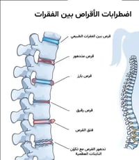 علاج طبيعي • اليرموك بغداد • انزلاق غضروفي
