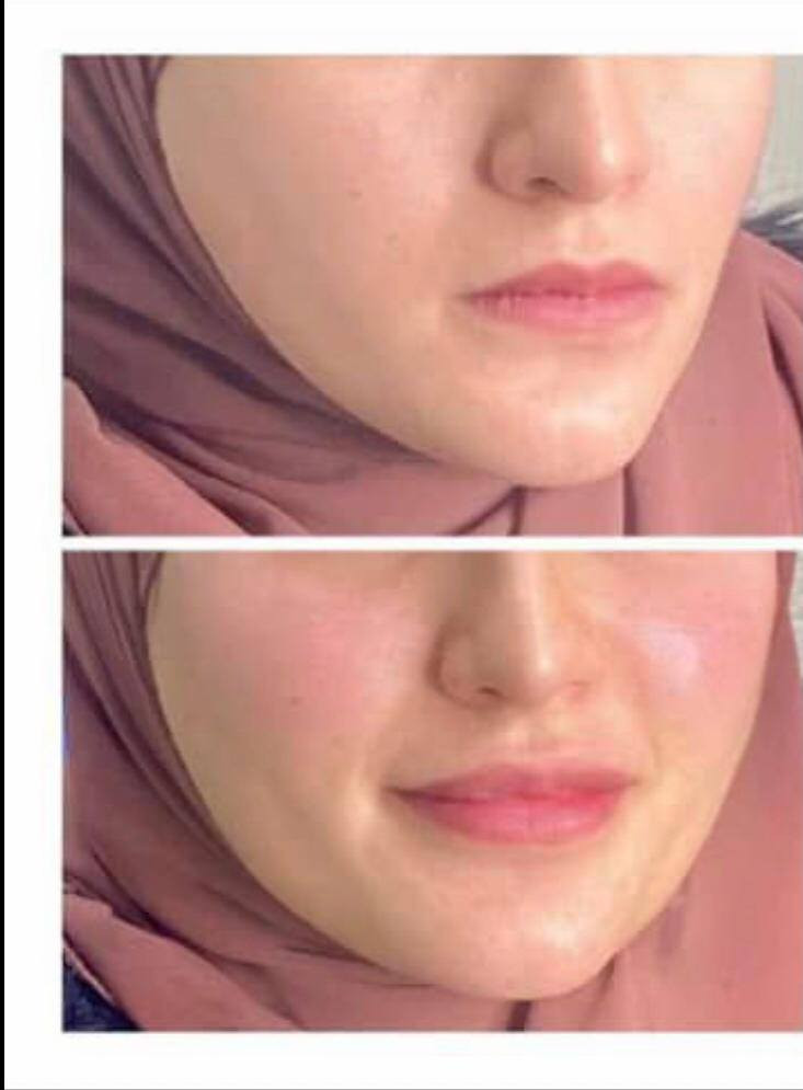 بنات شباب خلطه اسوي الوجه كيمر الله شاهد نمش تصبغات وهاي تجارب خلال يومين تزلغك زلغ


**إذا كنت صاحب هذا الإعلان وتريد حذفه لأي سبب، رجاءا أرسل رسالة إلى الدعم الفني**