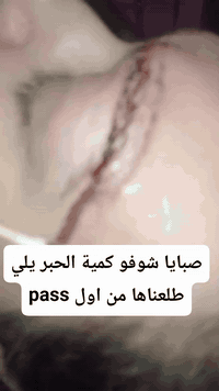 💥استعمال الالوان فوق تاتو قديم هو بس تغطية وبعدين مع الوقت بيصير عنا تشكيلة الوان غريبة وشو ما عملنا فوقن ما بيطلع حلو.. والبيج والابيض من اصعب الالوان بالازالة وافضل طريقة بهيدي الحالة هيي الازالة بالأحماض
ازالة تاتو حواجب لكل الالوان بنفس الجلسة و بدون التسبب بأي ضرر للجلد واكيد عم نمحي بمواد مخصصة ما عم نغطي بألوان🪻
#بسمايةـبلوكb1/104☄️
🪻لحجز موعد او الاستفسار تواصل عالدايركت او عالواتسآب *********** 📱

 #tattooremoval #eyebrowstattooremoval  #badtattooremoval #eyebrowsartist #ازالة_تاتو #ازالةتاتو #نانوريموڤال #ازالةتاتوالحواجب
#nanoremoval_by_me #nanoremoval_Basmayah
 #nanoremoval_Bagdad
