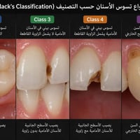 تسوس • علاج مجاني • جامعة الفراهيدي