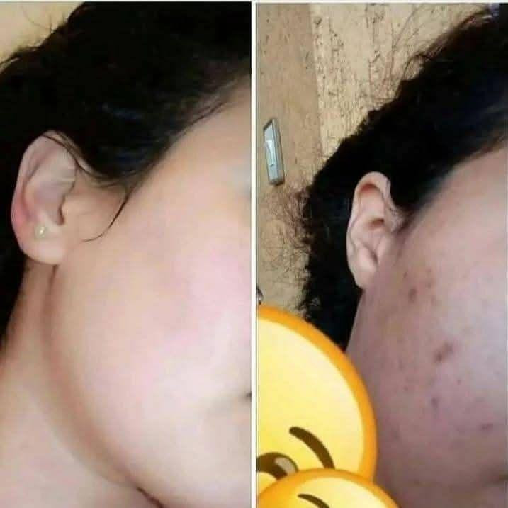 تجربه زبونه علا منتج 💋
بنات اصلي ومجرب أكثر من ١٠٠ مرة 
يعالج الكلف نمش اثار حبوب يعني تصفيه كامله للبشره 💋
تبيض نعومه يعني تصير بشرة مال طفل ومن اول عصاره 💋
سعره جدآ جدآ مناسب 
توصيل متوفر جميع المحافظات💋

#متابعه #تعليق #لايك #مشاركه #اغاني بغداد, العراق


**إذا كنت صاحب هذا الإعلان وتريد حذفه لأي سبب، رجاءا أرسل رسالة إلى الدعم الفني**