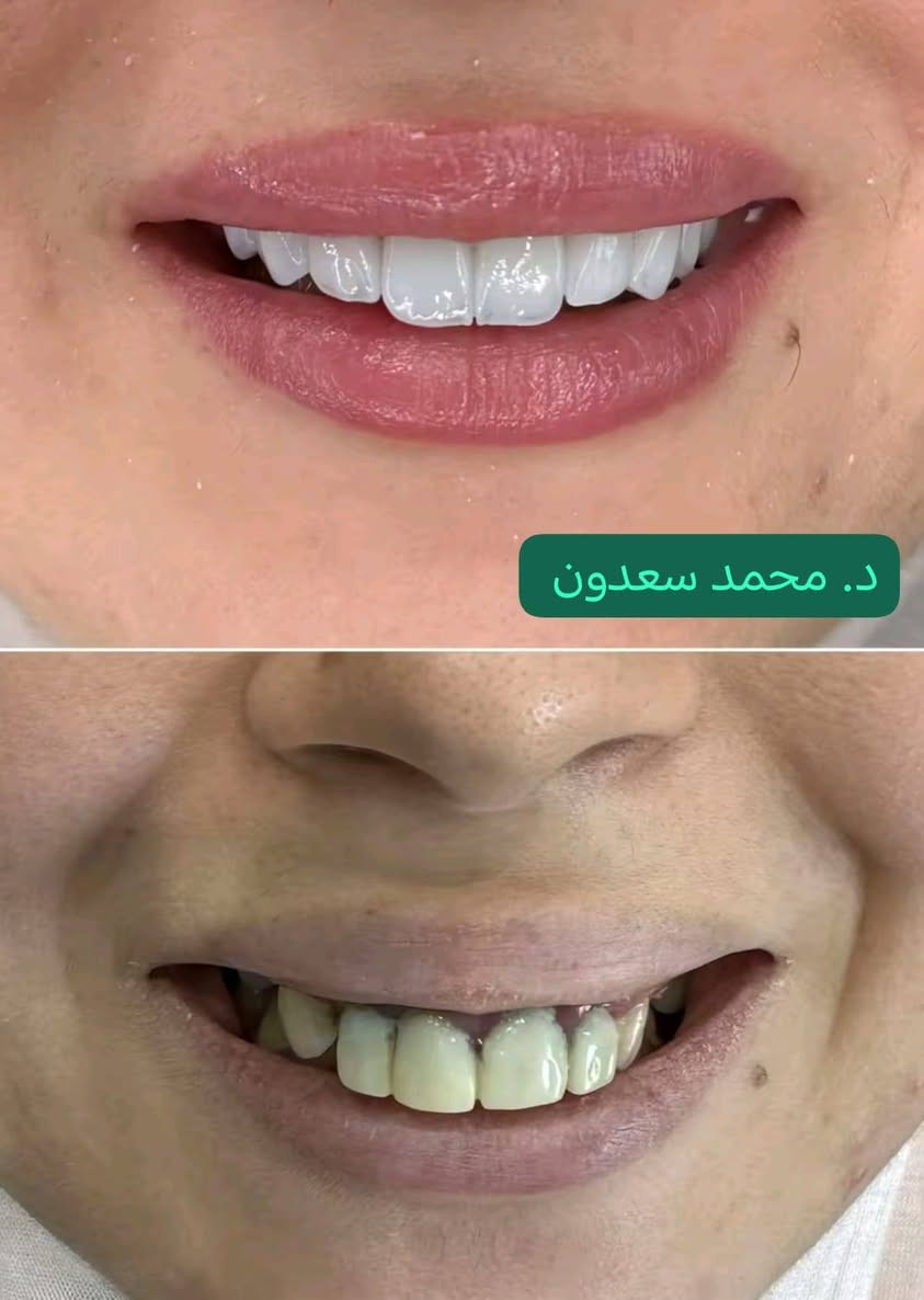 أحلا وأجمل العروض
1- قسم الاسنان 
حشوات تجميليه ب20 ألف أو 25 الف حسب تلافه ألسن 
تنضيف أسنان وبولش للاسنان ب 20 ألف 
تركيب الزاركون الألماني السن الواحد 75 ألف مع تنضيف أسنان واللثة مجاني بعد العمل

2-قسم التجميل والحقن للرجال والنساء 
فلر شفه أو وجنات 25 ألف 
تغيير شامل 250 الف
بلازما مفعله للوجه أو للشعر 15 الف
ميزو تساقط الشعر 35 الف
ميزو نضاره البشره 35 الف
ميزو تصبغات 35 الف
تنضيف عميق للبشره 15 الف

3-قسم الليزر 
ليزر الكانديلا الثلجي 
جلسه ازاله التاتو 10 الف
ليزر ازاله الشعر 15 الف
ليزر تحديد وجنات 15 الف 
ليزر رقبه كامل 20 الف
ليزر فل بدي جسم كامل 120 الف

مركز ايفا لتجميل الوجه والأسنان العنوان مدينة الصدر الكياره قطاع٦٧ مقابل نادي الجولان
‏‪***********‬‏📞

فحص ومعاينة مجاني يوميا مع اشعه للاسنان#
