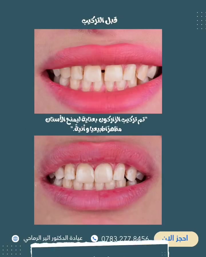 "تمت إعادة بناء الابتسامة بتركيبات الزاركون  المتقنة، لتحقق مظهرًا طبيعيًا راقيًا يجمع بين الجمال والثقة." 🤍✨🦷

 (عيادة الدكتور أثير حليم الرماحي) 

☎️ للحجز والاستفسار ***********
او مراسلة الصفحة 

📍 الموقع: 
الديوانية- قضاء عفك/شارع الأطباء قرب صيدلية أكرم البديري بناية الدكتورة مروة حمود التميمي الطابق الثاني

#ابتسامتك_تستحق_الأفضل #عيادة_اسنان
#حشوات_تجميليه_حشوات_جذر_قلع_جراحي_تركيب_اسنان
#اكسبلورexplore #قضاء_عفك
