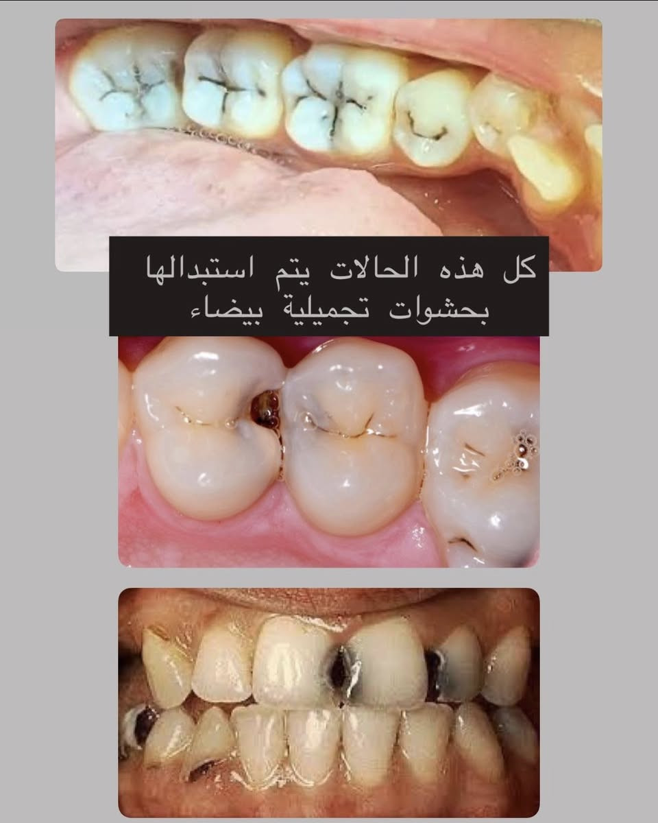 تبحث عن علاج مجاني وآمن؟✨
نلتقيكم في عياداتنا!
📅 بدأنا نستقبل الحالات في عيادات جامعة كركوك !

🔹 الخدمات المتوفرة:
 •قلع الأسنان
 •الحشوات
 •تنظيف الأسنان
 •أطقم الأسنان

سارعوا بالحجز، الحجوزات محدودة !

💌 للحجز والتفاصيل: مراسلة الصفحة او التواصل على الرقم ***********

