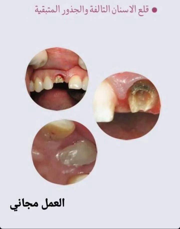 مجانا مجانا مجانا 
تعلن كلية طب الأسنان في جامعة واسط (العيادات التعليمية) عن استمرار استقبالها للمراجعين الكرام الراغبين في الحصول على الخدمات العلاجية، وبإشراف مباشر من قبل نخبة من الأساتذة والأطباء الأختصاص.
الخدمات المتاحة
حشوات جذر
حشوات عادية 
تنظيف اسنان 
حشوات اطفال 
قلع 

***********
