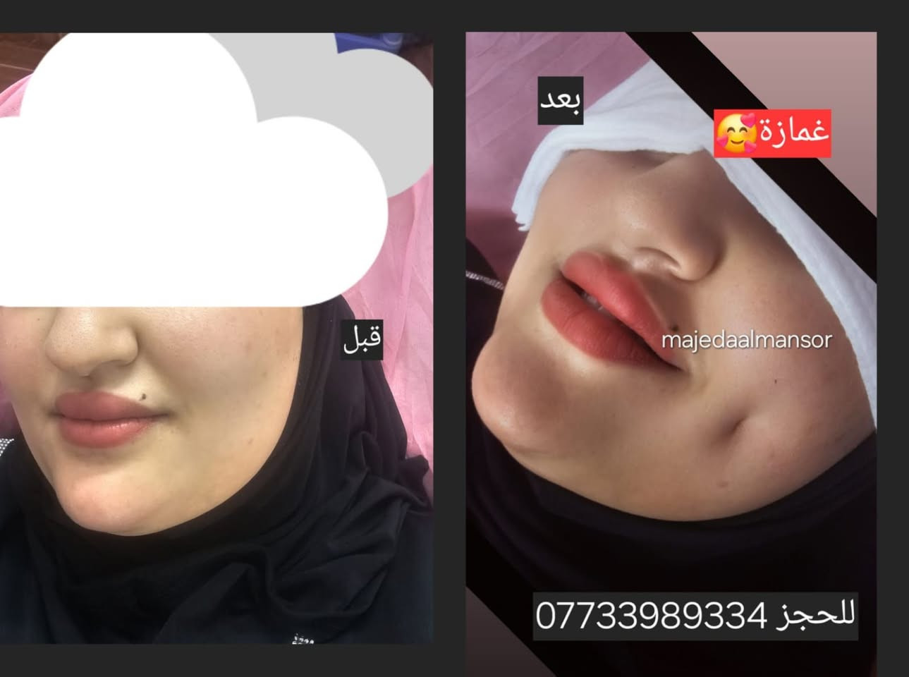 فيلر الشفايف وصل لأجمل نتيجة طبيعية!
إذا تحبين شفايف ممتلئة ومتناسقة بدون مبالغة، هسه تكدرين تحصلين على لوك ناعم وجذاب بلمسة احترافية ✨
ع يد خبيرة التجميل والمدربة الدولية
 الدكتورة ماجدة المنصور Jojo Alnabeel 
العنوان بغداد الحسينية مقابل السوق الكبير مجاور مرطبات العذراء
مجمع سما الحسينيه للطابق الثاني قسم التجميل والصالون ***********
