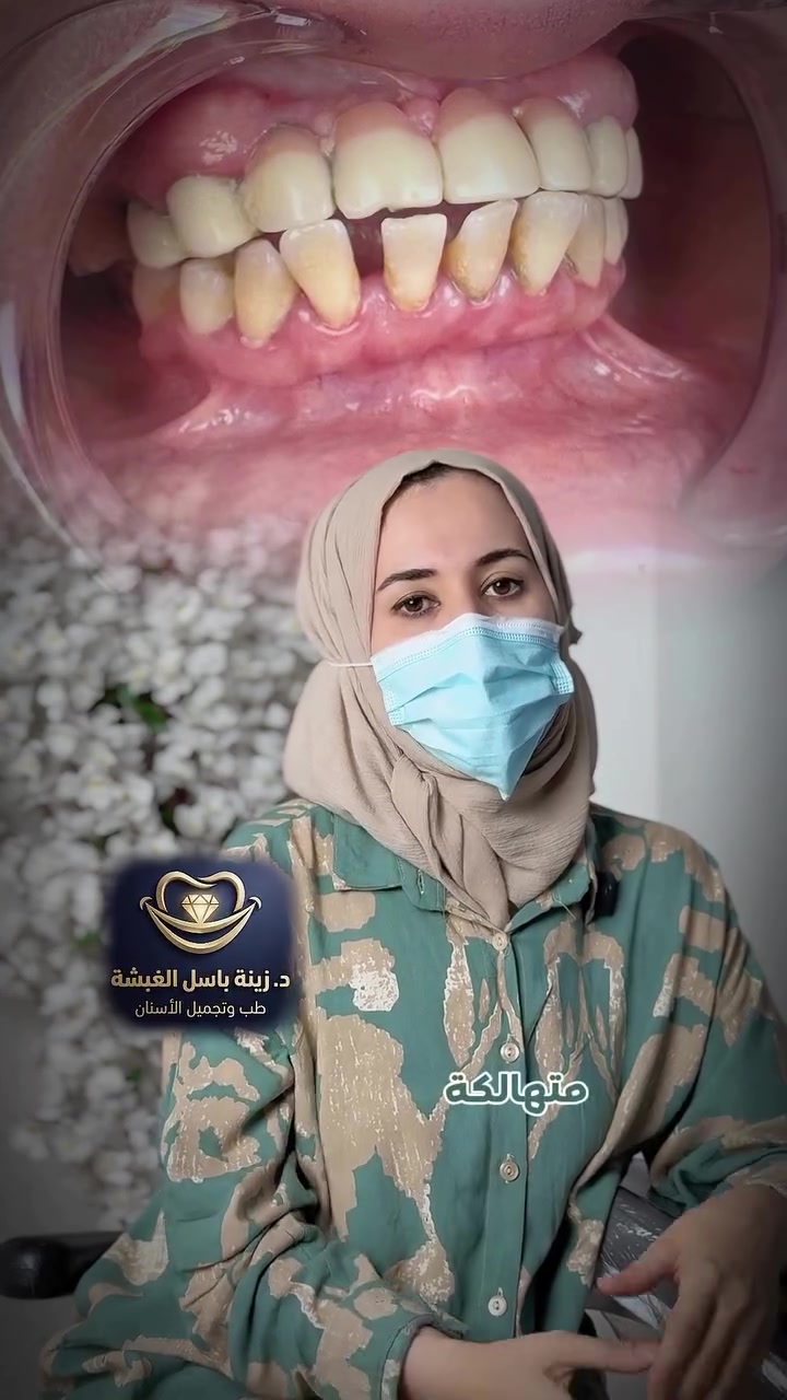 هل الخوف من طبيب الأسنان يمنعك من الحصول على الابتسامة التي تستحقينها؟ 🤔✨
في هذا الفيديو، نستعرض قصة نجاح وتحدٍ مزدوج (طبي ونفسي) مع الدكتورة زينة باسل الغبشة.
حالة لمريضة عانت من تجربة سابقة غير ناجحة تركت تلفاً كبيراً في أسنانها الأمامية، مما ولّد لديها "فوبيا" وخوفاً شديداً من مراجعة عيادات الأسنان.
بعد الفحص الدقيق، تبين وجود تحديات طبية كبيرة تتمثل في فقدان العظم وصعوبة إجراء الزراعة المباشرة، لكن بالصبر، والتواصل الفعال، والخطة العلاجية الدقيقة (خطوة بخطوة)، تم كسر حاجز الخوف تماماً!
النتيجة؟ تحول جذري من أسنان متهالكة إلى ابتسامة صحية، طبيعية، ومشرقة أعادت للمريضة ثقتها بنفسها وبأطباء الأسنان. 🌟
👩‍⚕️ الدكتورة زينة باسل الغبشة
بكالوريوس طب وجراحة الفم والأسنان - جامعة الموصل.
📍 العنوان:
الموصل - حي الجامعة - بالقرب من جامع بشار قلندر.
📞 للحجز والاستفسار:
***********
***********
💬 شاركنا في التعليقات.. هل تعاني من الخوف من عيادات الأسنان؟ فريقنا الطبي هنا لمساعدتك في التغلب عليه براحة تامة!
#طب_الأسنان #تجميل_الأسنان #ابتسامة_طبيعية #الدكتورة_زينة_الغبشة #فوبيا_الأسنان الموصل حي_الجامعة صحة_الفم العراق
