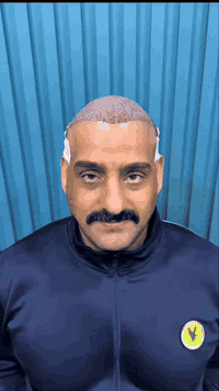 اسمع رأي الزبون بعد الزرع مباشرة.. 
مو كل واحد زراعته تنجح… تعال خل نشوف حالتك 
ونجاوبك بصراحة اذا تصيرلك زراعة او لا .. 
.. 
📱 واتساب | اتصال 📞
***********
