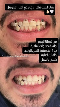 سن مكسور؟ فراغات؟ تصبغات مضايقتك بكل صورة؟ 👀✨ لا تعيشها بعد… هسة تگدر ...