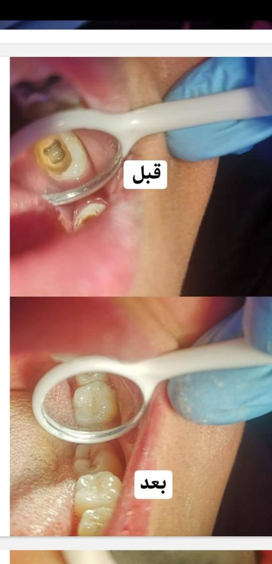 ✨ عروض مميزة على جميع خدمات طب الأسنان… ابتسامتك بأفضل سعر!
🦷 ابتسامة صحية بأسعار رمزية لا تفوت الفرصة!
💎 خصومات خاصة على تنظيف وتجميل الأسنان لفترة محدودة!
🌟 لأن ابتسامتك تهمنا… نقدم لك أفضل العروض بأعلى جودة!
🔥 عروض حصرية على علاجات الأسنان… احجز الآن وابتسم بثقة!

عيادة الارجوان لطب الاسنان/ سبع البور شارع الاربعتالاف 4000 ضمن مجمع دكتوره ديانا الزبيدي
واتساب ***********
