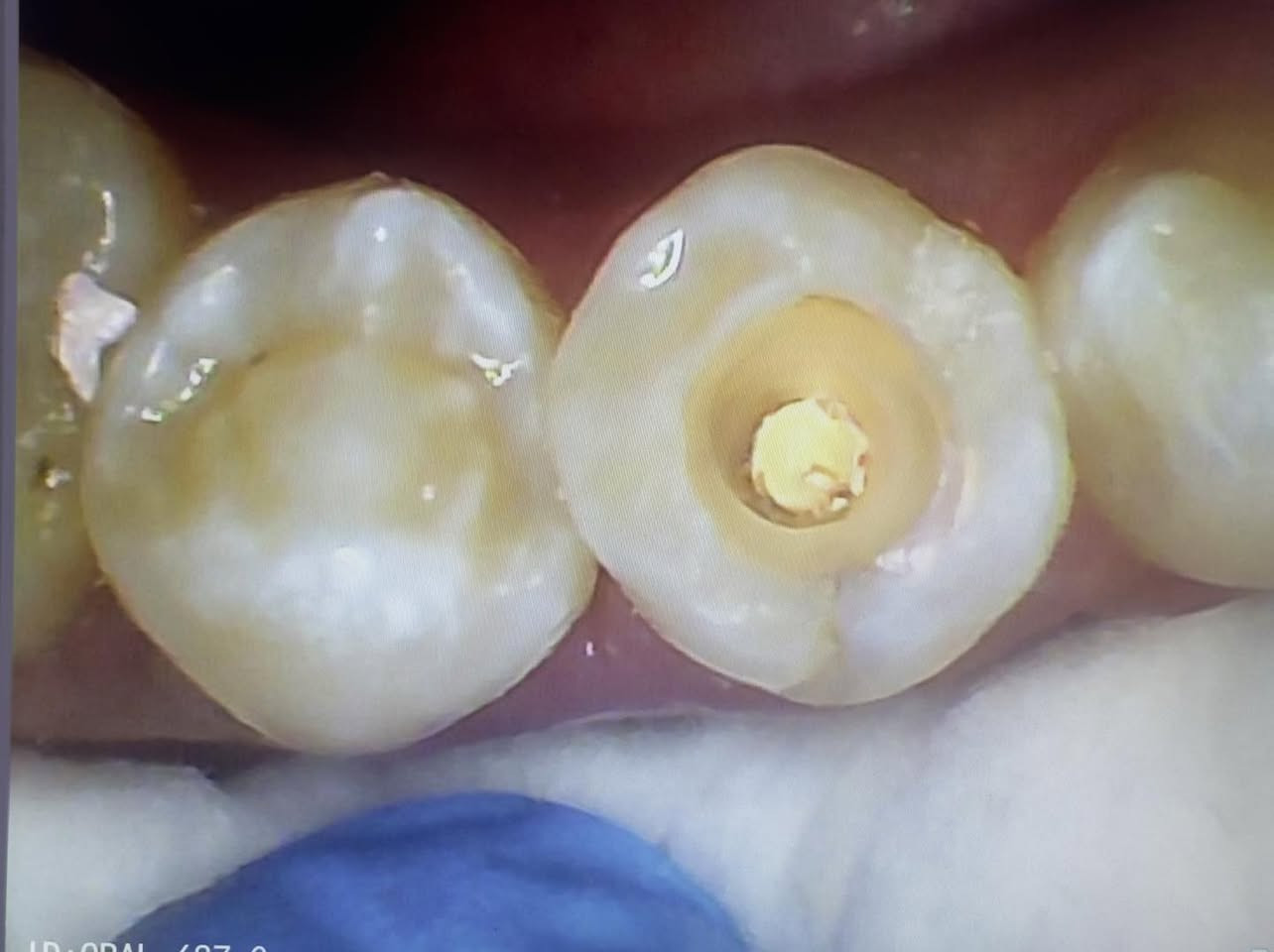 حشوة جذر للسن الخلفي
طبيب الاسنان الاختصاص د.عمار عباس
ماجستير تقويم وتجميل الاسنان M.S.c ortho
بكلوريوس طب وجراحة الفم والأسنان B.D.S
بغداد الشعب شارع عدن قرب  مركز شرطة الشعب  مدخل سوق شلال عمارة باريس الطابق الاول دوام العيادة جميع ايام الاسبوع ما عدا الجمعة عطلة من ٤ ل ٨  بدون حجز مسبق الدخول حسب اسبقية الحضور للعيادة الفحص والمعاينة مجاني للاستفسار ***********
