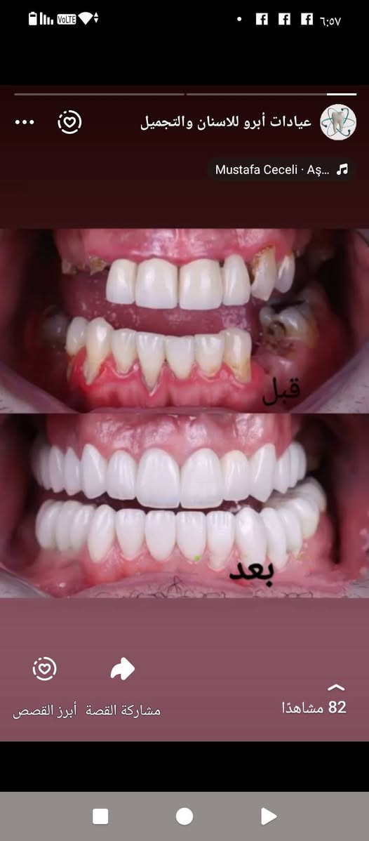 تعلن عيادات إبرو لطب الاسنان وتجميل عن عروض وتخفيضات في قسم الأسنان وتجميل مكان  العياده ماجديه نهاية شارع الجامع مقابيل مأكولات البيك ***********
