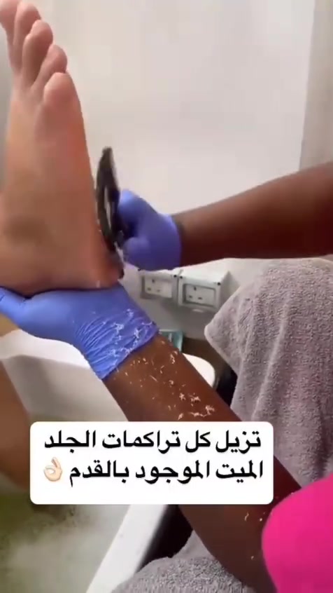 ✨ متوفر توصيل مادة الكالوس فقط لجميع المحافظات ✨
وداعاً للجلد الميت والتشققات والخشونة 👣🤍
✔️ يساعد على إزالة الجلد الميت المتراكم
✔️ يساهم في تنعيم القدم وتحسين مظهرها
✔️ سهل الاستخدام
✔️ مناسب للعناية بالقدمين
🚚 توصيل لجميع المحافظات
💵 الدفع عند الاستلام
📩 للحجز والاستفسار راسلينا خاص 💕🔥


**إذا كنت صاحب هذا الإعلان وتريد حذفه لأي سبب، رجاءا أرسل رسالة إلى الدعم الفني**