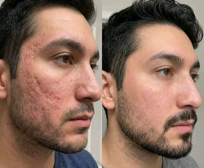 بسعر 7 الف دينار والتوصيل مجاني 
يشهد الله خلطه مضمونه ومجربة وفعاله تبيض فوري للبشرة وتصفية كامله منوالنمش والكلف والهالات السوداء والحفر وحب الشباب واثار الحب نتائجها تظهر خلال ٣ أيام من الاستعمال والقران جرب وشوف النتائج 
للحجز ارسل رقمك وعنوانك على الخاص


**إذا كنت صاحب هذا الإعلان وتريد حذفه لأي سبب، رجاءا أرسل رسالة إلى الدعم الفني**