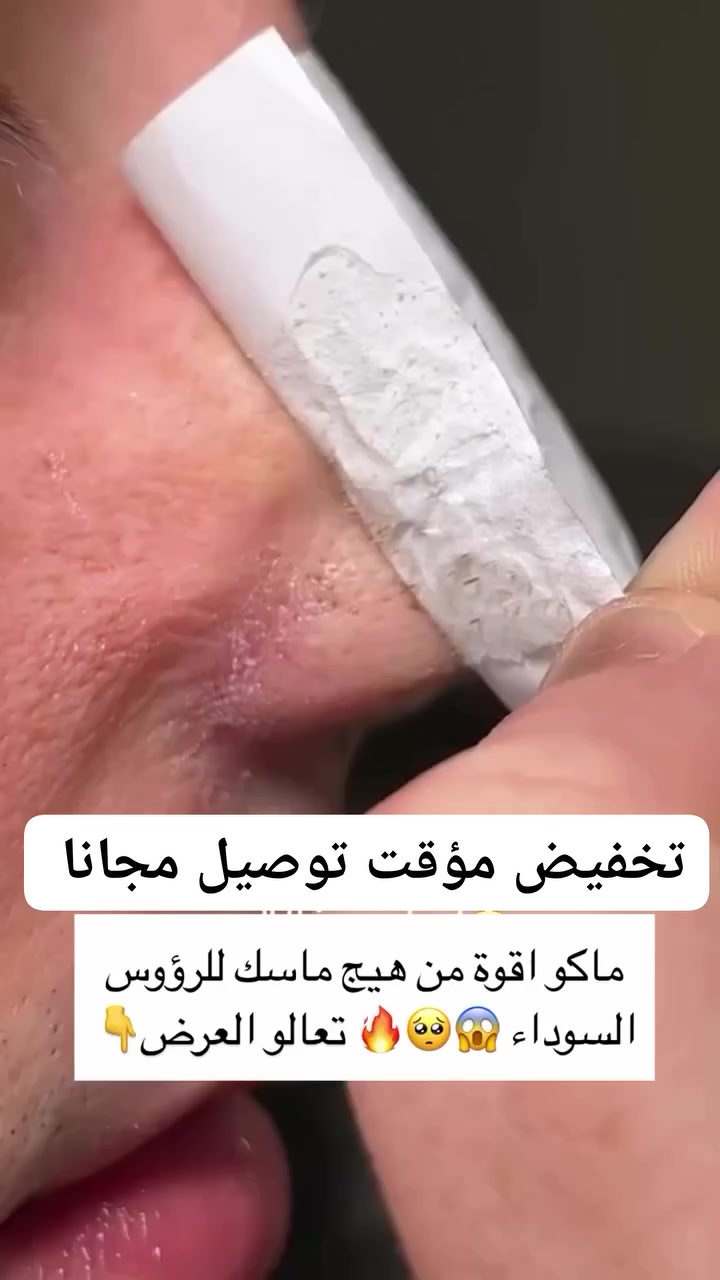 ماسك لابينا لإزالة الرؤوس✨ ❤️
لازالة الرؤس السوداء وتنظيف الانف وتطهير العميق
لأنف للتنظيف العميق وإزالة الرؤوس السوداء وحب الشباب وتقليص المسام. 
✔️ يساعد البشرة على التنفس ويزيل البثور الرؤوس السوداء والبيضاء والجلد الميت من غير مايسبب اي تلف او ضرر لبشرتك .
✔️يعدل افراز الدهون ويساعد علي تقليص حجم المسام 👏🏻
توجد خدمة توصيل


**إذا كنت صاحب هذا الإعلان وتريد حذفه لأي سبب، رجاءا أرسل رسالة إلى الدعم الفني**