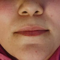 فيلر • حقن تجميل