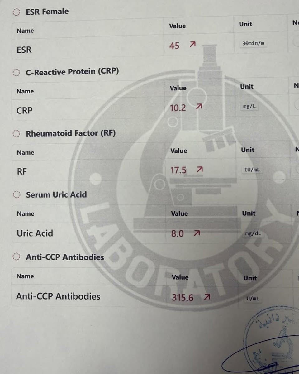 حالة مرضية مؤثرة… عندما يكون الألم رسالة إنذار

مريضة بعمر 30 سنة
وصلت إلى العيادة وهي غير قادرة على الحركة،
تمشي باستخدام حجلة رباعية بسبب ألم شديد في الركبة.

لكن المشكلة لم تكن في الركبة فقط…
كانت تعاني أيضًا من ألم وتيبّس في مفاصل اليدين والرجلين،
والأعراض مستمرة منذ فترة من دون علاج أو مراجعة طبية.
⸻
🔍 ماذا كشف الفحص؟
▪️ الركبة متورّمة، حارّة، مع ألم شديد
▪️ سونار المفصل أظهر:
 • التهاب نشط
 • تجمع سوائل
 • تمزّق في الغضاريف

▪️ التحاليل المختبرية:
📈 هجمة روماتيزم رثوي
القيم أكثر من 300 (الطبيعي يقارب 20)

▪️ الأشعة:
⚠️ سوفان درجة رابعة في مفصل الركبة
➡️ تلف مبكّر ناتج عن التهاب المفصل الرثوي
➡️ الحاجة إلى تبديل مفصل الركبة
⸻
🩺 الخطة العلاجية

✅ شرح طبيعة المرض كحالة مزمنة تحتاج التزام
✅ وضع خطة علاجية للسيطرة على نشاط المرض
✅ التحضير الصحي لإحالة المريضة إلى الجراح المختص
🔁 تبديل المفصل يتم بعد استقرار الحالة والسيطرة على الالتهاب
⸻
✅ التشخيص النهائي
هجمة روماتيزم رثوي ضاربة مفصل الركبة
RA Knee Arthritis
⸻
🟦 رسالة مهمة:
آلام المفاصل عند الشباب ليست أمرًا بسيطًا،
والتشخيص المبكر قد ينقذ المفصل ويمنع الإعاقة.
⸻
📍 بغداد – الحبيبية
📞 ***********
👨‍⚕️ د. أحمد حسين العوادي 

#روماتيزم_رثوي #ألم_المفاصل #ألم_الركبة #RA #طب_المفاصل #تشخيص_مبكر #Baghdad
