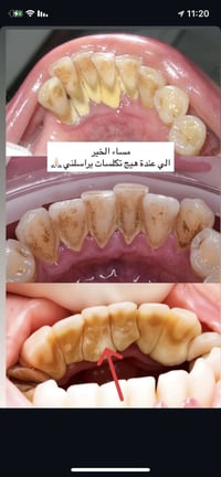 العلاج مجانا بالكامل للحجز والاستفسار ‭0781 557 1456‬