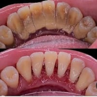 جامعة كربلاء • علاج أسنان • شبه مجاني