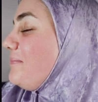 علاج تصبغات • توحيد لون • بغداد