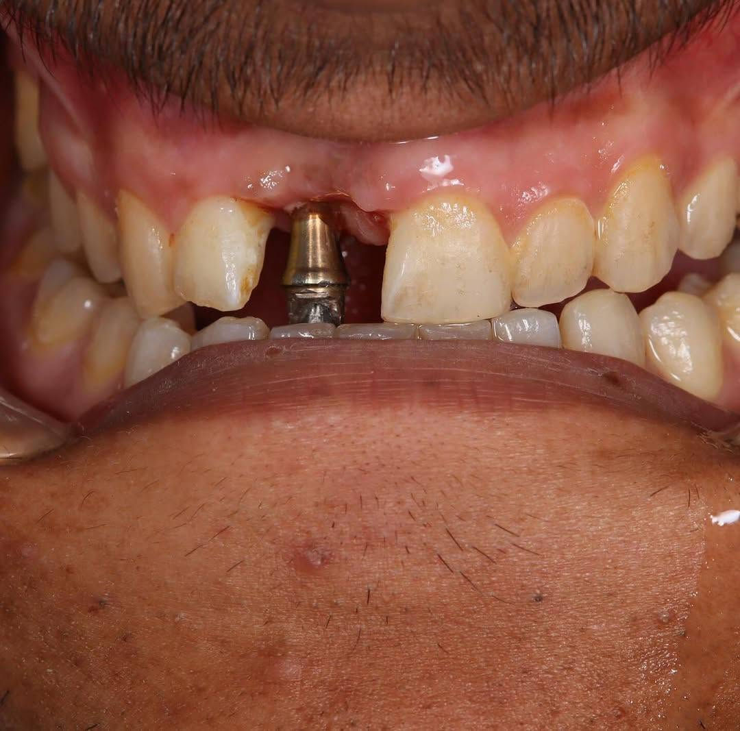 فقدت سناً؟ لا تفقد ابتسامتك!
زراعة السن الواحد هي الحل الأقرب للطبيعة لتعويض الفراغ بحل دائم، آمن، ومريح. استعد ثقتك وابتسامتك الكاملة اليوم.
احجز موعدك الآن! ***********
