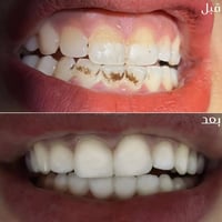 تنظيف الأسنان • إزالة الجير • واسط بدرة