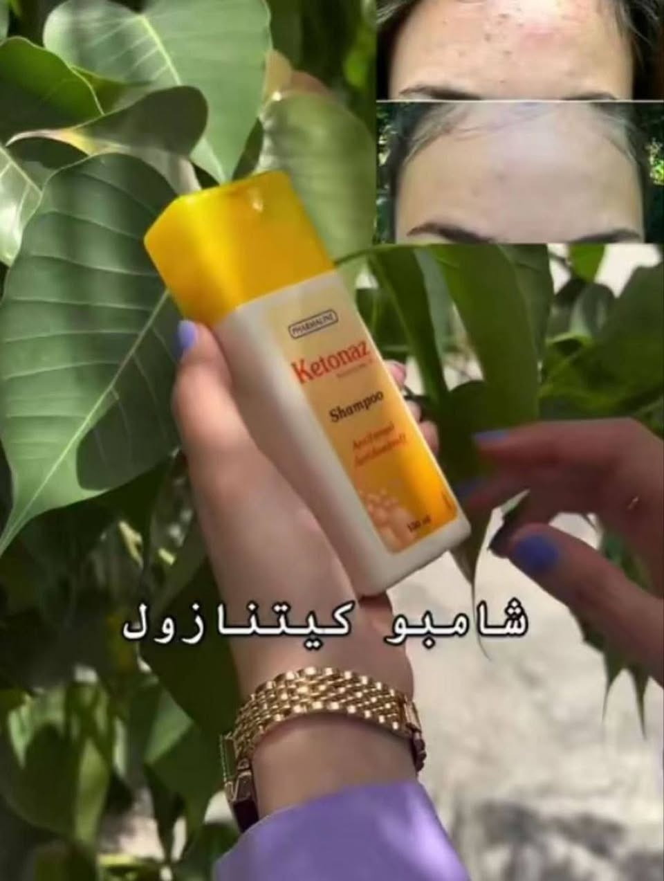 شامبو كيتوناز (Ketonaz)🇱🇧💯
شامبو  طبي يحتوي على المادة الفعالة كيتوكونازول بنسبة 2%. يتم استخدامه بشكل أساسي كشامبو مضاد للفطريات وقشرة الرأس. يستخدم شامبو كيتوناز لعلاج الالتهابات الفطرية على فروة الرأس  والجسم، والتي قد تسبب الحكة والتقشر ويعالج حبوب الجسم (الضهر - الوجه - اليدين - القدم - الفخذين - وحتى المناطق الحساسه )
✅الفوائد:-
✔️ يعتبر علاجاً فعالاً للقشرة المزمنة والمستعصية، ويخفف من الحكة المصاحبة لها.
✔️ يعالج التقشر الجاف أو الدهني لفروة الرأس وأجزاء أخرى من الجسم.
✔️يعالج السعفة وهي حالة تسبب ظهور بقع بيضاء إلى بنية اللون على الجلد، خاصة بعد التعرض للشمس.
✔️يعالج الأمراض الجلدية الفطرية الأخرى يستخدم لعلاج أنواع أخرى من العدوى الفطرية التي تصيب فروة الرأس أو مناطق أخرى من الجلد. 
⭕طريقة الاستخدام والجرعة
يُستخدم الشامبو على الشعر المبلل أو المنطقة المصابة من الجلد.يُدلك بلطف حتى تتكون رغوة، ويُترك لمدة 3 إلى 5 دقائق قبل شطفه جيداً بالماء
#الاصلي المنشأ لبنان 🇱🇧💯
سعر الدرزن 
يوجد لدينا توصيل الجميع محافظات العراق✔️✔️


**إذا كنت صاحب هذا الإعلان وتريد حذفه لأي سبب، رجاءا أرسل رسالة إلى الدعم الفني**