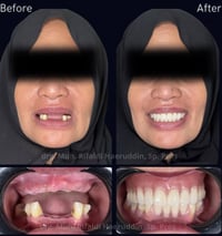 قلع أسنان • تنظيف أسنان • تركيب فك متحرك