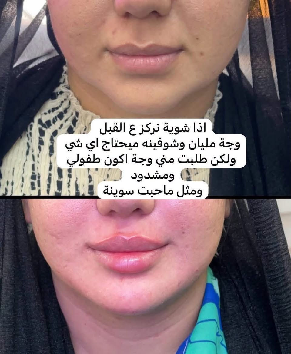 عروض مستمرة

الشهر #محرم #سنتر_تولاي مسابقه#شهر محرم 
تابع الصفه لايك مشاركه المنشور اخذ سكرين المسابقه تدخل القرعه 3فائزات 

1فلر شفه 

2ابره نضارة

3تنظيف بشرة 

المسابقه من يوم 30 لى 7/3

مجاناً مجاناً مجاناً 
فقط وصل 10

بلازما عادية 
بلازما مفعله 
بلازما +ميزو ثيرابي 

فلر شفه كوري اراستي 25
فلر رفع وجنات 50 
فلر اصدار 40
فلر تكساس 50

فلر تغير شامل كوري اراستي 100+هديه ابره نضارة 

فلر تغير شامل  فرنسي 150+
ابره نضارة 

كل هذه دلل فقط بسنتر تولاي 
عنوان بغداد الحسينية خدمات مسقط 
رقم الحجز واتساب 
***********
اشارة دفاع جوي ودفاع جوي فقط
#خاص_للنساء
#يعلن
#سنتر_تولاي
