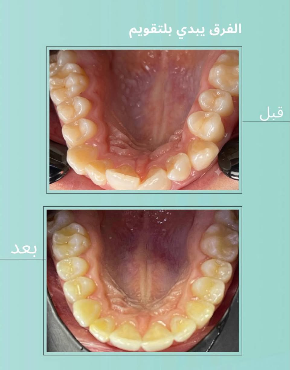 من أول زيارة إلى آخر موعد… كانت النتيجة ابتسامة تستحق كل خطوة ونشارككم إحدى رحلات التقويم الناجحة التي انتهت بنتيجة مميزة.

بإشراف الدكتورة آية عاصم

متواجدين يومياً من الساعة ٤ العصر وحتى الساعة ٩ مساء 

عيادة الإتقان لزراعة وتقويم الأسنان 

نستقبلكم بكل حب يومياً

للحجز والأستفسار الاتصال
***********

الطوبچي / مقابيل كوكتيل البركة، بداخل فرع صيدلية الابتغاء

#بغداد #عيادة_اسنان #عيادة_الإتقان⁩⁩⁩⁩⁩⁩⁩

