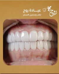 عيادة روح • زركون • تجميل أسنان