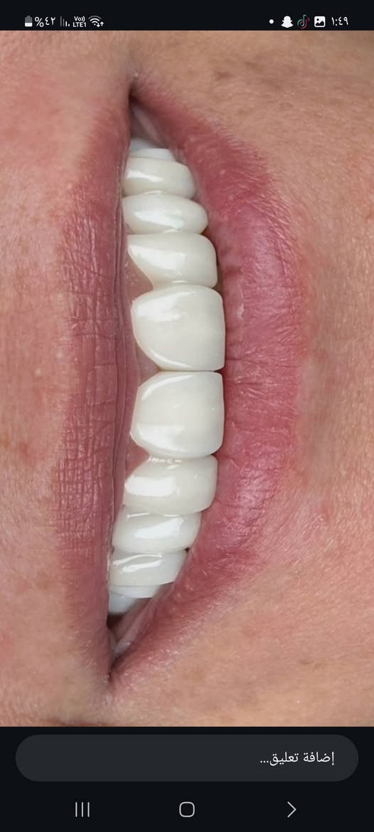 ابتسامتك تستحق الأفضل ✨🦷
إذا تبحثون عن ابتسامة أجمل وصحة أفضل لأسنانكم 🤍
نستقبلكم في عيادة الدكتور شاكر أحمد شاكر لتقديم خدمات طب وتجميل الأسنان 🦷✨
📸 نماذج من أعمال العيادة 👇🏻
نهتم بالتفاصيل حتى تحصلون على ابتسامة تليق بكم 🤍
📍 العنوان: قرب جسر ديالى القديم
📞 للحجز والاستفسار: ***********
✨ للحجز والاستفسار تواصلوا معنا ✨
#عيادة_الدكتور_شاكر_أحمد_شاكر
#طب_وتجميل_الأسنان
#تجميل_الأسنان
#ابتسامة_جميلة
#الزعفرانية
