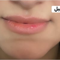كربلاء • حقن شفايف • تجديد الحقن
