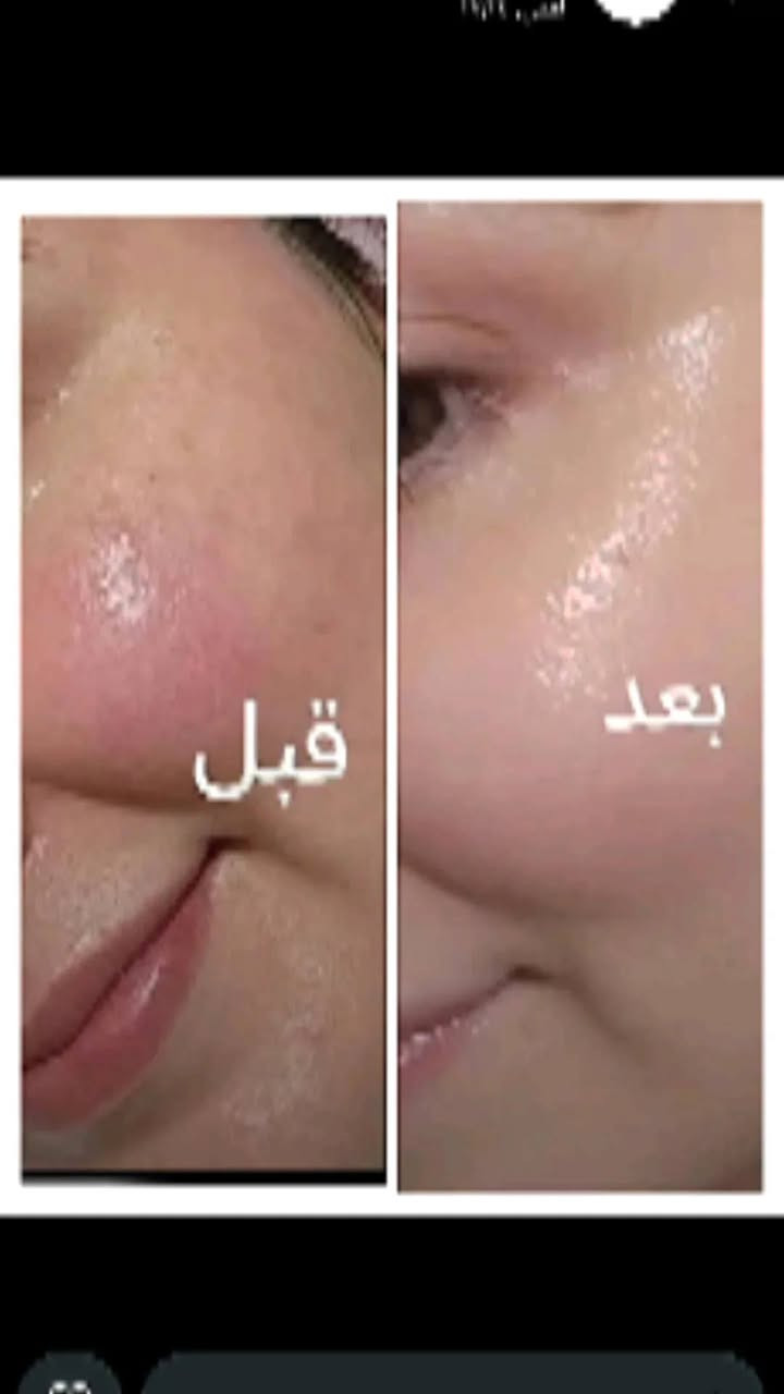 📣 عاجل  "جوري سكين الايراني"! بـ 18 ألف وبس والتوصيل بلاش!!! 📣 توفر توصيل داخل العراق الأول مره. 
بنات، أستغلو ا العرض@ شفتوا هاي الصور اللي بالمنشور؟ ، هاي حقيقة واقعية! نتائج تجنن وصدمة حقيقية لزبوناتنا اللي قرروا ينهون معاناتهم مع مشاكل البشرة! 💯💥
تعبتي من حب الشباب وآثاره اللي مخربة وجهج؟
سوّيتي تقشير وندمتي لان سوالج تصبغات؟ 
المناطق الحساسة والركب والأكواع مسببت لج إحراج؟ (شوفي الصورة 
تردين بشرة زجاجية ونعومة خيالية مثل "الكيمر"؟ 
الحل السحري لكل مشاكلج صار بين ايدج! 😉
مقشر جوري سكين مو بس مقشر، هو الحل النهائي والجذري! بتركيبة فريدة تشتغل على عمق البشرة، تجددها، تفتّحها، وتخفي كل التصبغات والآثار. ✅✨
عرض "جوري سكين" الذهبي (اللي ما يتكرر):
بمناسبة العطلة، ولأننا نحب نفرحكم، سوينا الكم أقوى عرض بالعراق:
🎁 مقشر جوري سكين بـ 18 ألف دينار بس!!!
🎁 والتوصيل مجاني لكل مناطق العراق!!!
أي نعم، التوصيل بلاش عليكِ! يعني بس تدفعين 18 ألف والمقشر يوصلج لبيتج! 🚗💨
لحكي، لا تضيعين الفرصة! الكمية محدودة جداً والطلب هواي، والكل يريد يجرب النتائج الحقيقية! 🏃‍♀️🏃‍♀️🏃‍♀️
احجزي مقشرج الآن ببلاش التوصيل! راسلينا على الخاص
#جوري_سكين #بشرة_زجاجية #نتائج_حقيقية #قبل_وبعد #تفتيح_المناطق_الحساسة #عناية_بالبشرة #حب_الشباب #آثار_حب_الشباب #تصبغات #عرض_العطلة #توصيل_مجاني #العراق #ميسان #بغداد #البصرة #اربيل #اكسبلور #تريند #جمال #نعومة #كيمر


**إذا كنت صاحب هذا الإعلان وتريد حذفه لأي سبب، رجاءا أرسل رسالة إلى الدعم الفني**